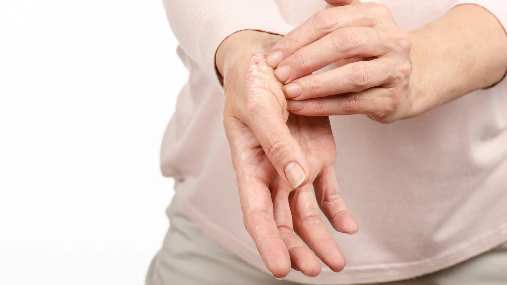 Psoriazisul-O-afectiune-dermatologica-cu-posibile-complicatii-pentru-intregul-organism RoyalRichRO