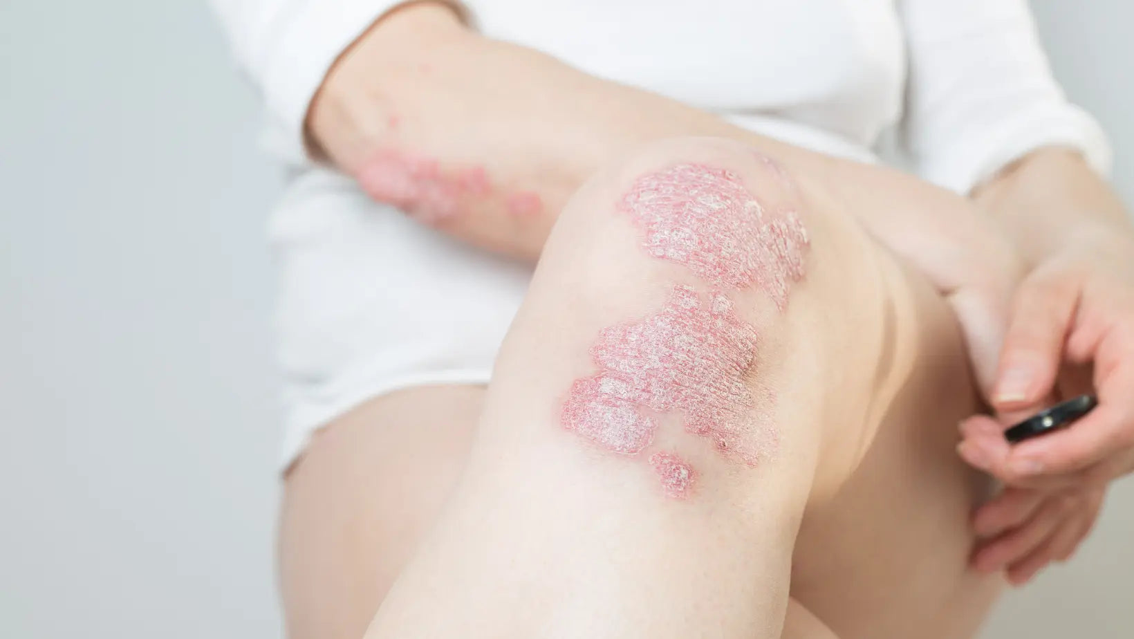 Viața-cu-psoriazis-în-România-Află-ce-drepturi-ai RoyalRichRO